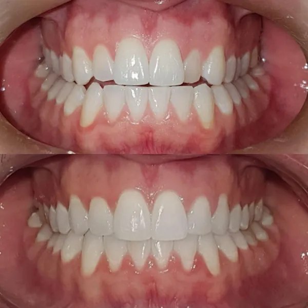 Antes e depois ortodontia — Hera Odontologia