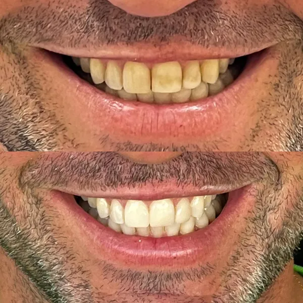 Antes e depois clareamento — Hera Odontologia