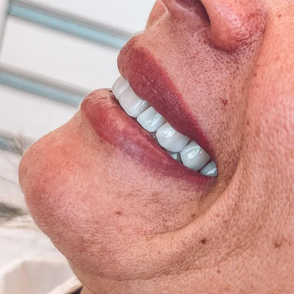Facetas dentais resultado — Hera Odontologia