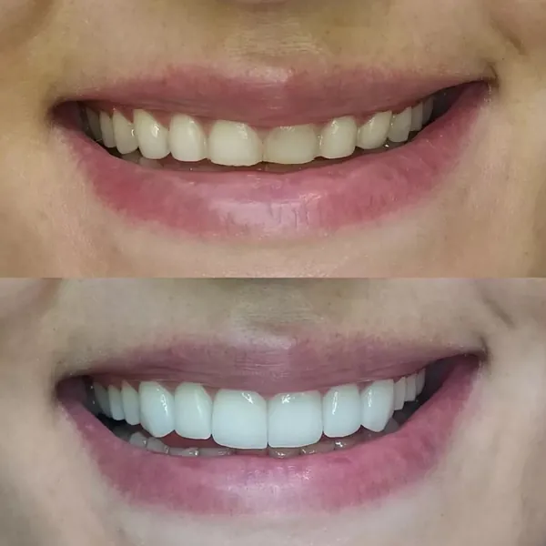 Antes e depois lentes de contato dental — Hera Odontologia