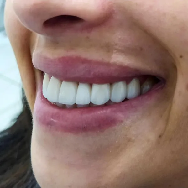 Sorriso com facetas — Hera Odontologia