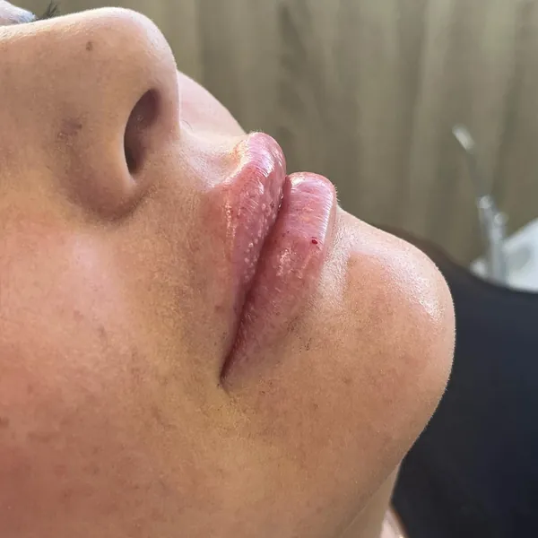Harmonização labial — Hera Odontologia